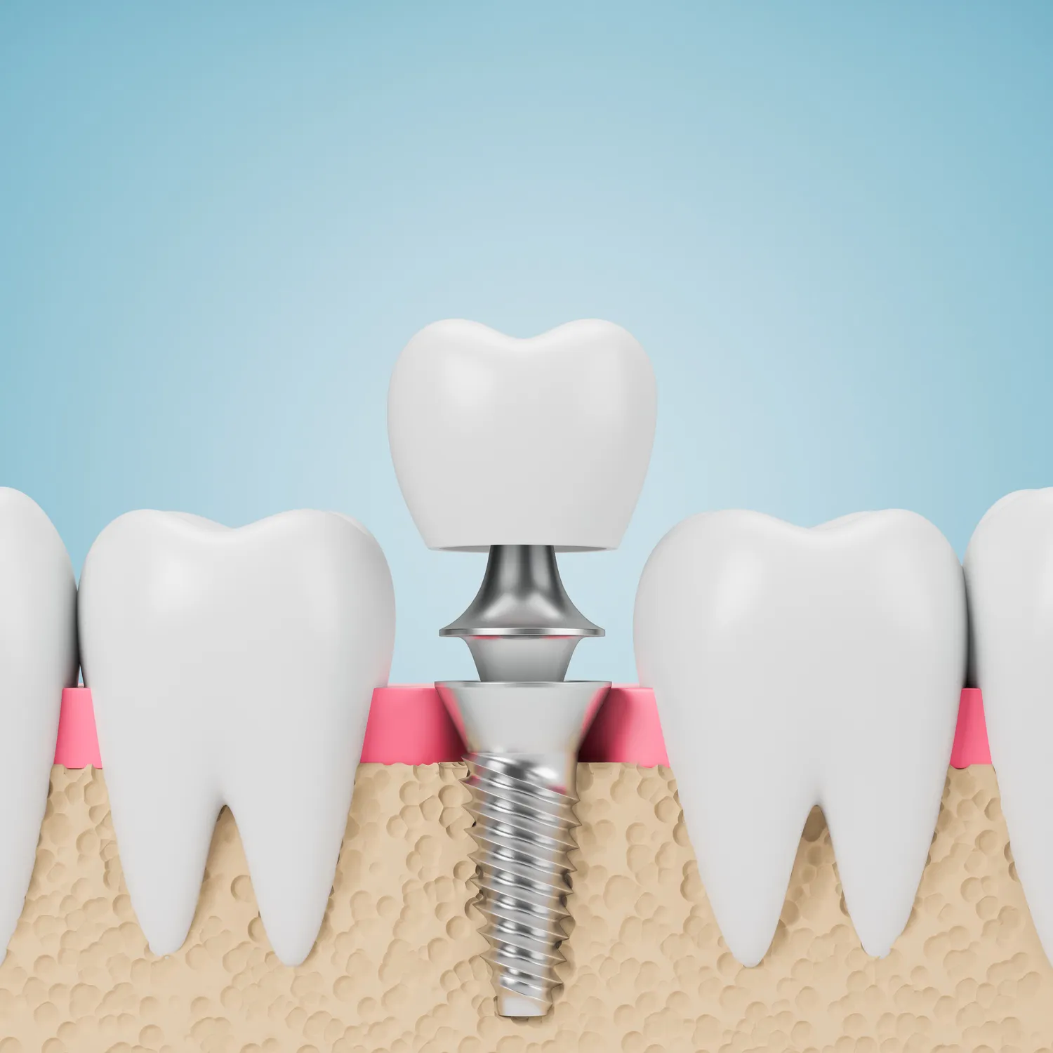 Implanty dentystyczne Warszawa